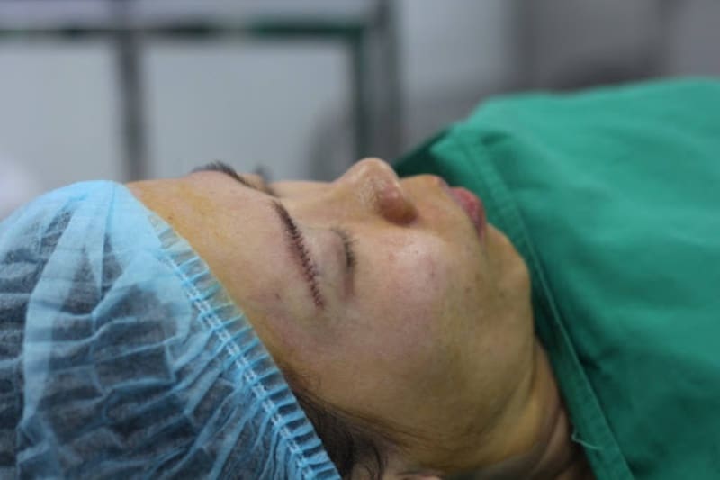 Nâng cung mày bao lâu thì hết sẹo? 4 nguyên nhân gây sẹo sau khi nâng chân mày