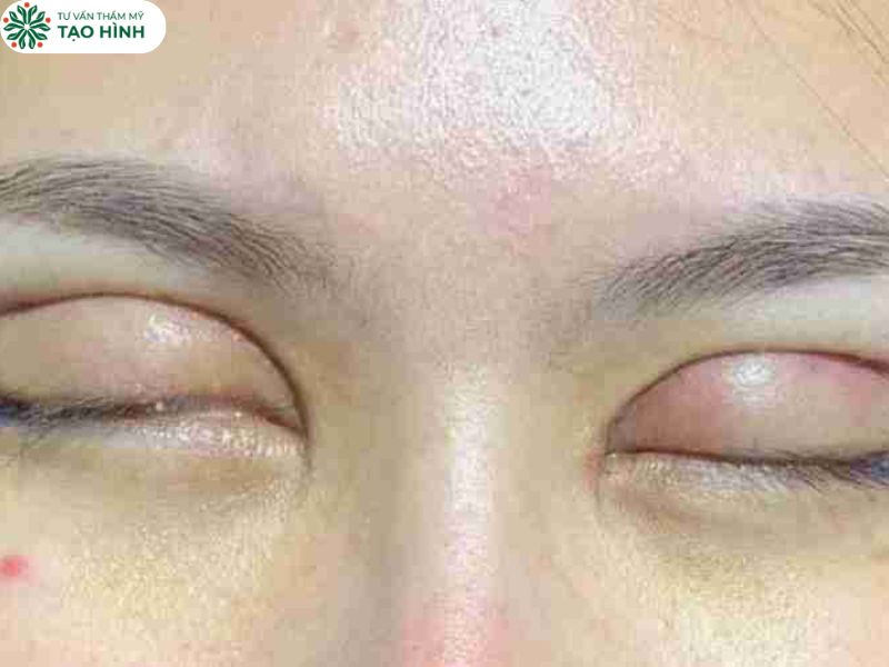 sửa mắt lỗi sau cắt mí