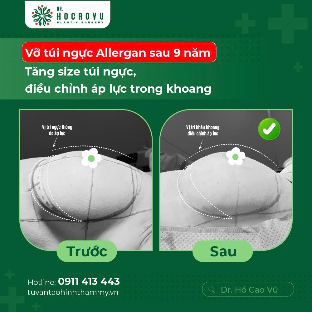 Nâng ngực bao lâu thì hết căng cứng? Mốc thời gian hồi phục theo từng giai đoạn