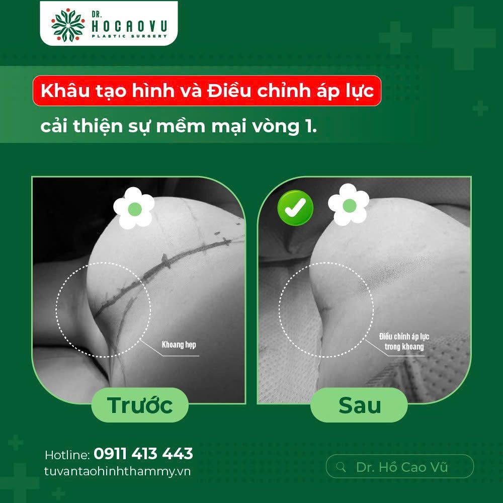 Nâng ngực bao lâu thì hết căng cứng? Mốc thời gian hồi phục theo từng giai đoạn