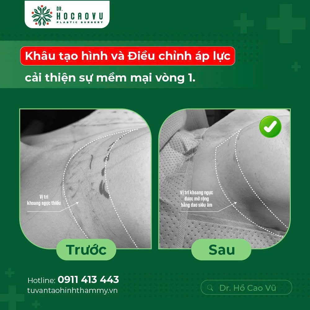 Nâng ngực bao lâu thì hết căng cứng? Mốc thời gian hồi phục theo từng giai đoạn