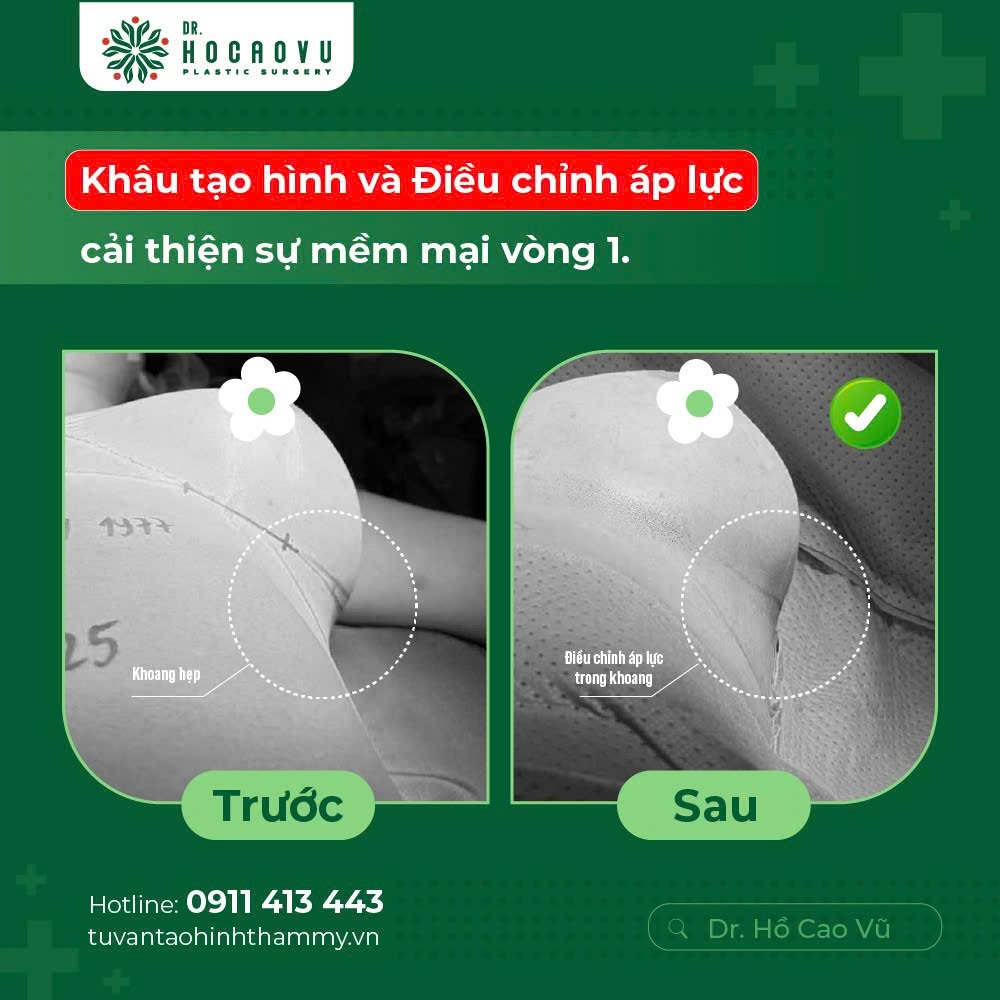Nâng ngực bao lâu thì hết căng cứng? Mốc thời gian hồi phục theo từng giai đoạn