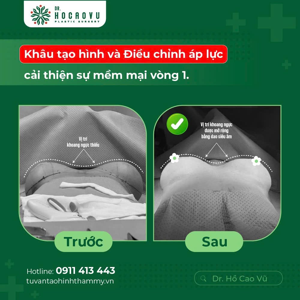 Nâng ngực bao lâu thì hết căng cứng? Mốc thời gian hồi phục theo từng giai đoạn