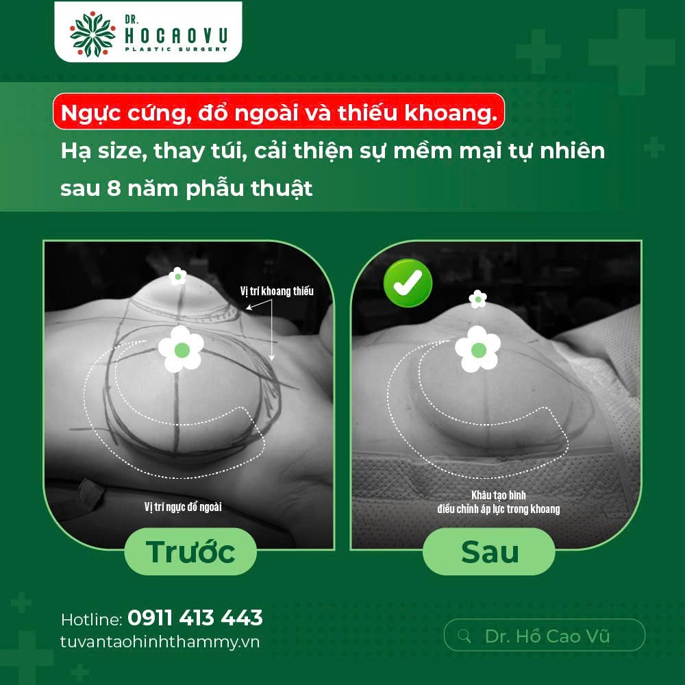 Nâng ngực bao lâu thì hết căng cứng? Mốc thời gian hồi phục theo từng giai đoạn