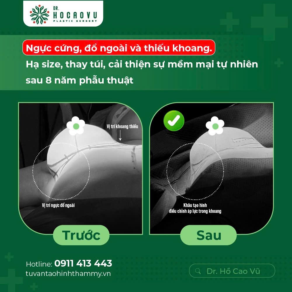 Nâng ngực bao lâu thì hết căng cứng? Mốc thời gian hồi phục theo từng giai đoạn