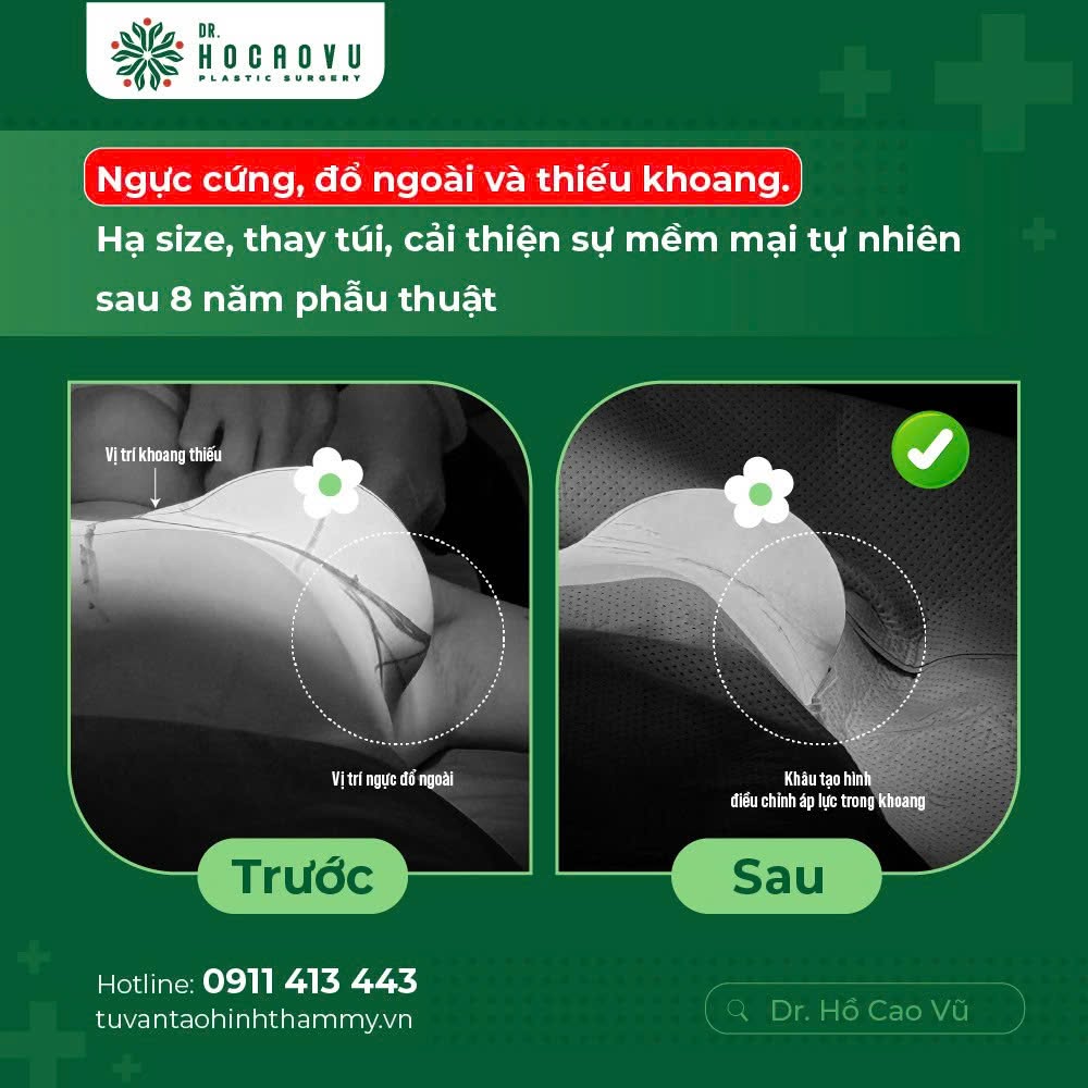 Nâng ngực bao lâu thì hết căng cứng? Mốc thời gian hồi phục theo từng giai đoạn