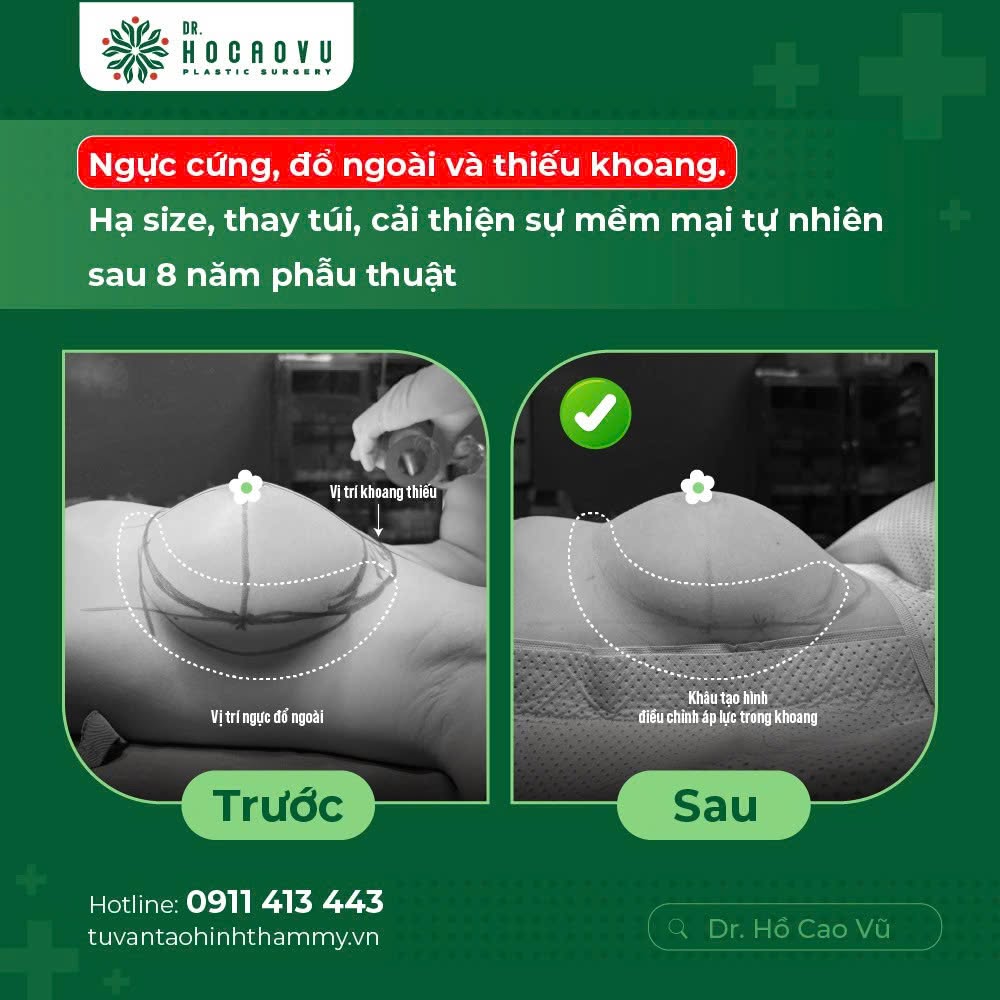 Nâng ngực bao lâu thì hết căng cứng? Mốc thời gian hồi phục theo từng giai đoạn