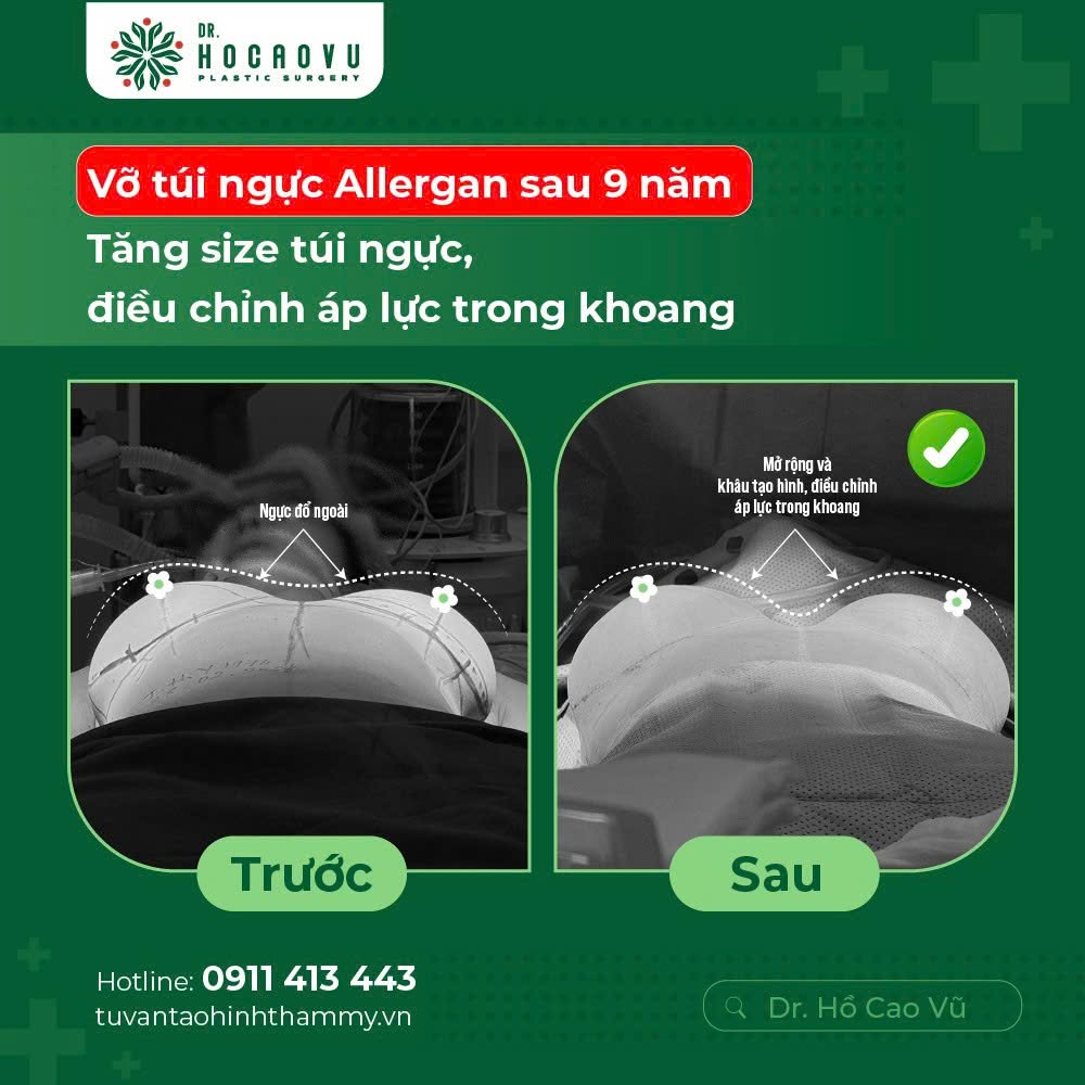 Nâng ngực bao lâu thì hết căng cứng? Mốc thời gian hồi phục theo từng giai đoạn