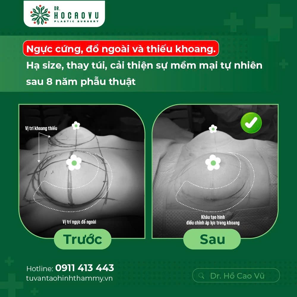 Nâng ngực bao lâu thì hết căng cứng? Mốc thời gian hồi phục theo từng giai đoạn