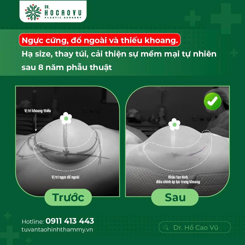 Nâng ngực bao lâu thì hết căng cứng? Mốc thời gian hồi phục theo từng giai đoạn