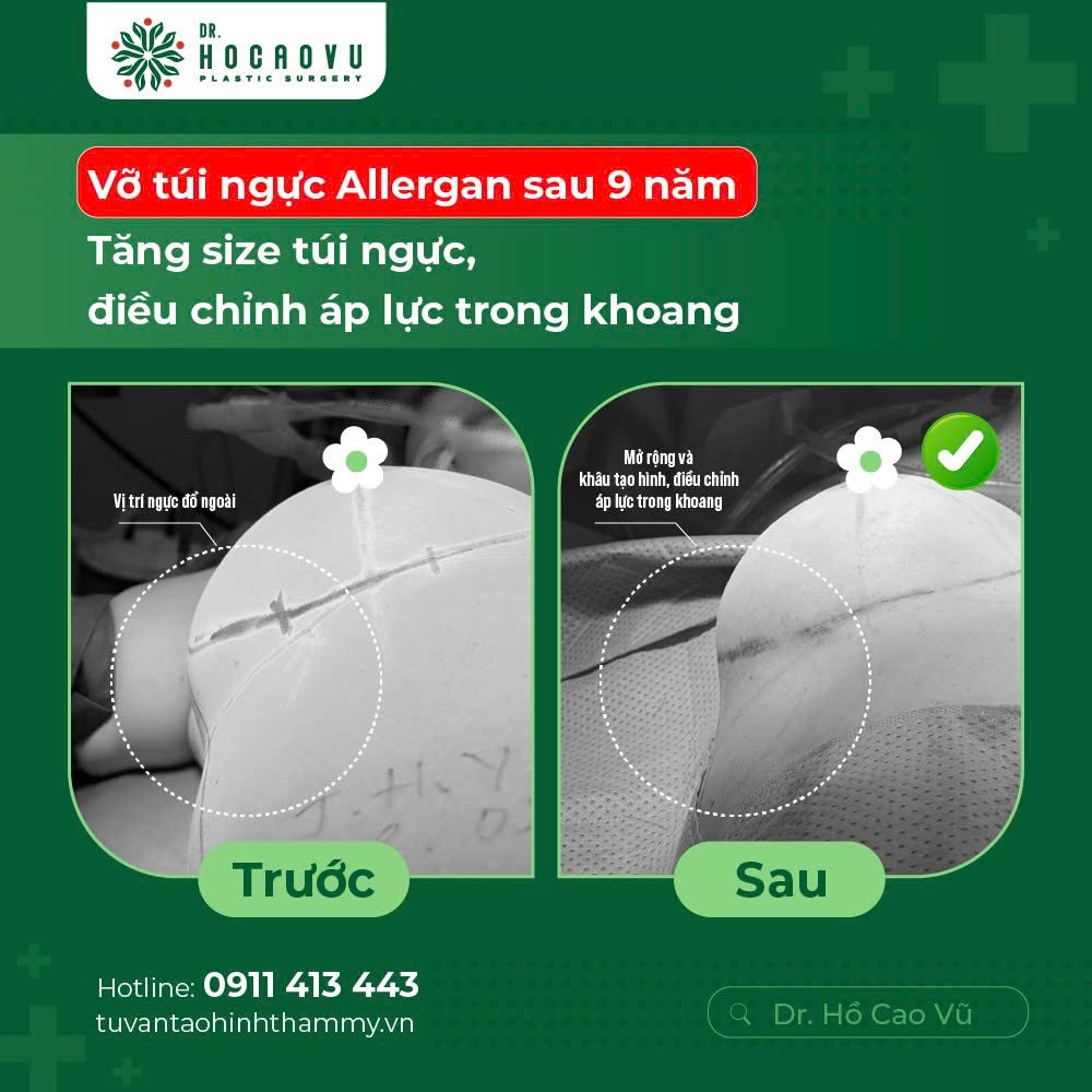 Nâng ngực bao lâu thì hết căng cứng? Mốc thời gian hồi phục theo từng giai đoạn