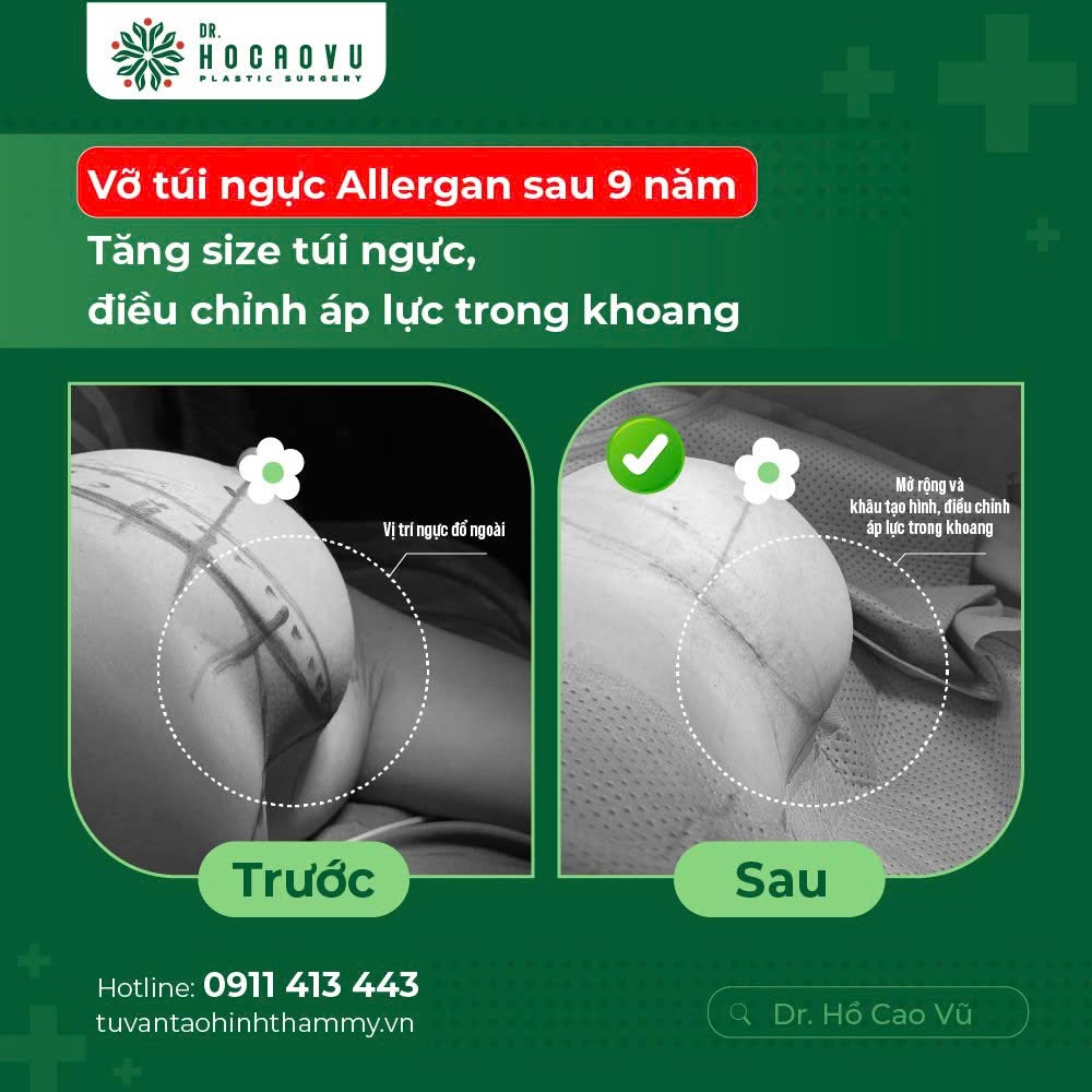 Nâng ngực bao lâu thì hết căng cứng? Mốc thời gian hồi phục theo từng giai đoạn